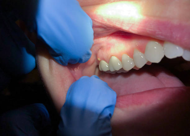 Best Emergency Dentist for Lost Fillings or Crowns in Hays, MT