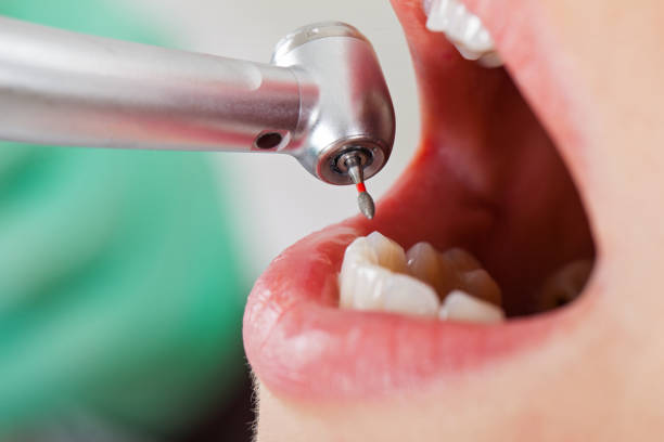 Best Emergency Dental Extractions in Hays, MT